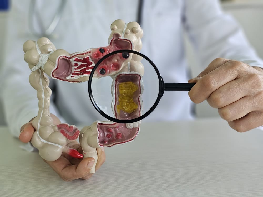 Colonoscopic Polyp Removal 